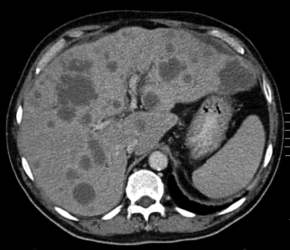 Abdominal CT scan showing diffuse liver metastases. | Open-i