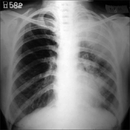 Chest Xray of a 56yearsold lady with an acute exacer