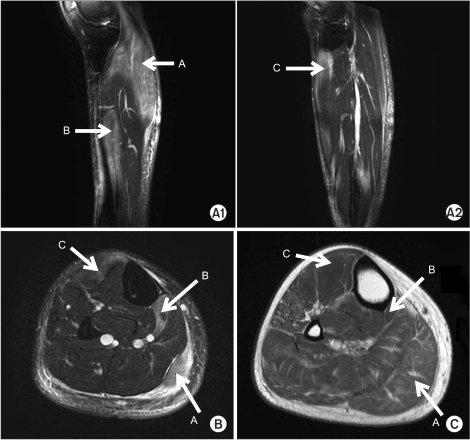 Results of right leg MRI. A1 and A2 display Sagittal T2 | Open-i