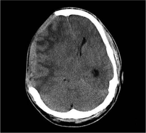 Brain computed tomographic scan after lumbar puncture r | Open-i