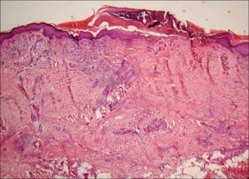 4× Magnification Ulcerated Epidermis With Scale Crust Open I