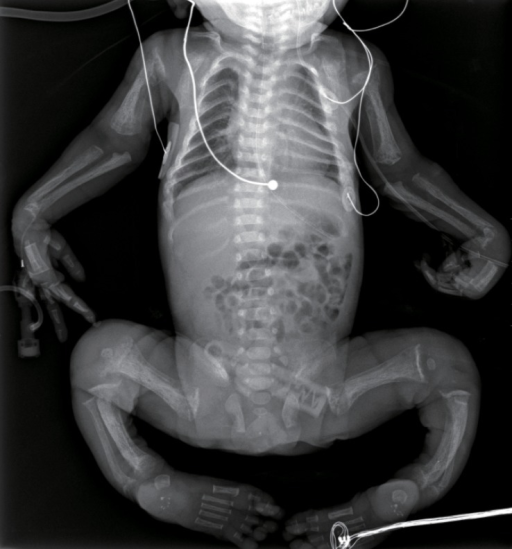 An Infantogram Showing Diffuse And Severe Osteopenia Of Open i an-infantogram-showing-diffuse-and-severe-osteopenia-of-open-i