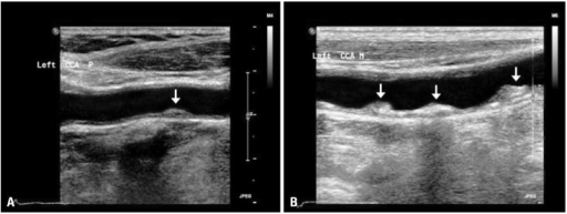 Abnormal Carotid Artery Ultrasound