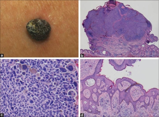 (a) A dark brown nodule with verrucous surface on the b | Open-i