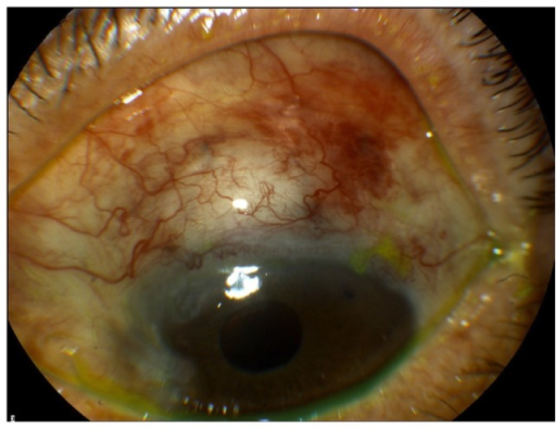 Cystic bleb of the amniotic group at 2 weeks post-op. T | Open-i