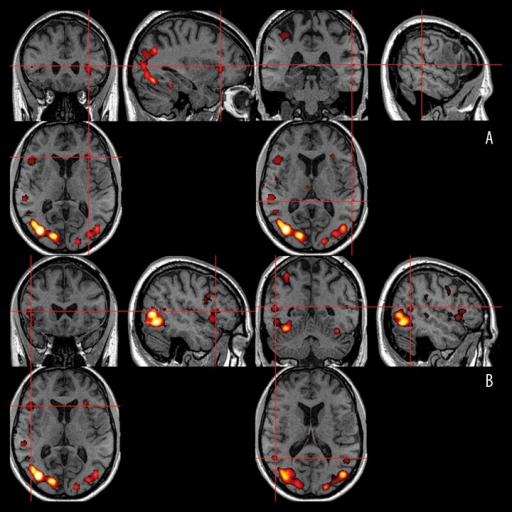 Sagittal, Coronal And Axial Views Of The Broca’s And | Open-i