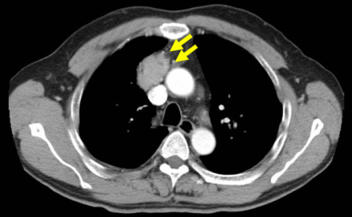 Enhanced Chest Ct Scan Revealing A 42 Mm Sized Solid Ma Open I