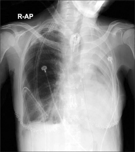 tracheostomy ray chest after postoperative lung injury without reperfusion open right figure any sign