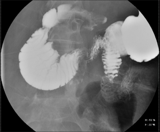 Barium swallow: Extrinsic compression of the 3rd portio | Open-i