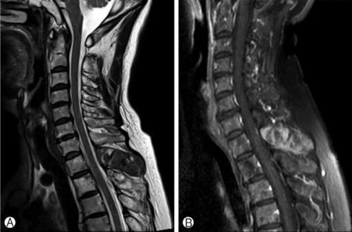 Cervical MRI image. (A) Sagittal T2-weighted image show | Open-i