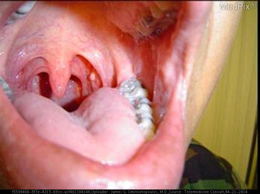 grossest-video-ever-tonsil-cyst-popping-youtube