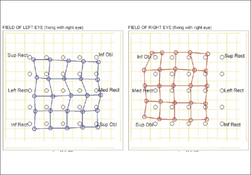 hess chart showing small hypertropia in the right eye a open i hess charting