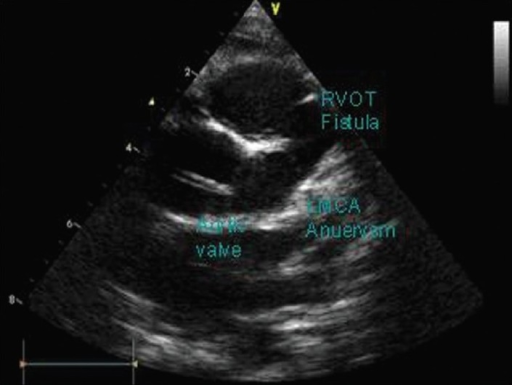 Echo image showing large left coronary artery aneurysm | Open-i