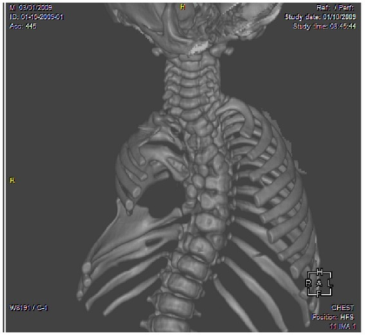 Three-dimensional CT scan AP thoracic image revealing f | Open-i