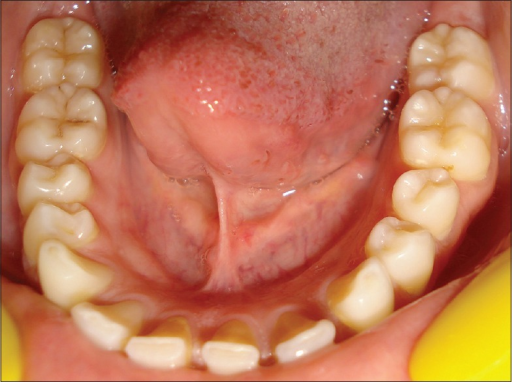  Mandibular  right first molar showing 6  right se Open i