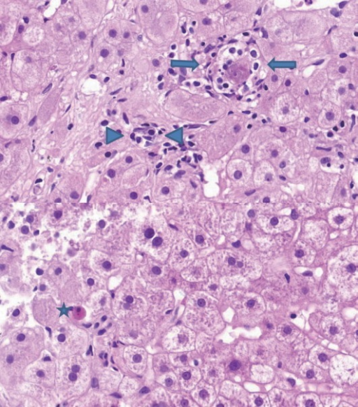 Lobular inflammation. A focus spotty necrosis of hepato | Open-i