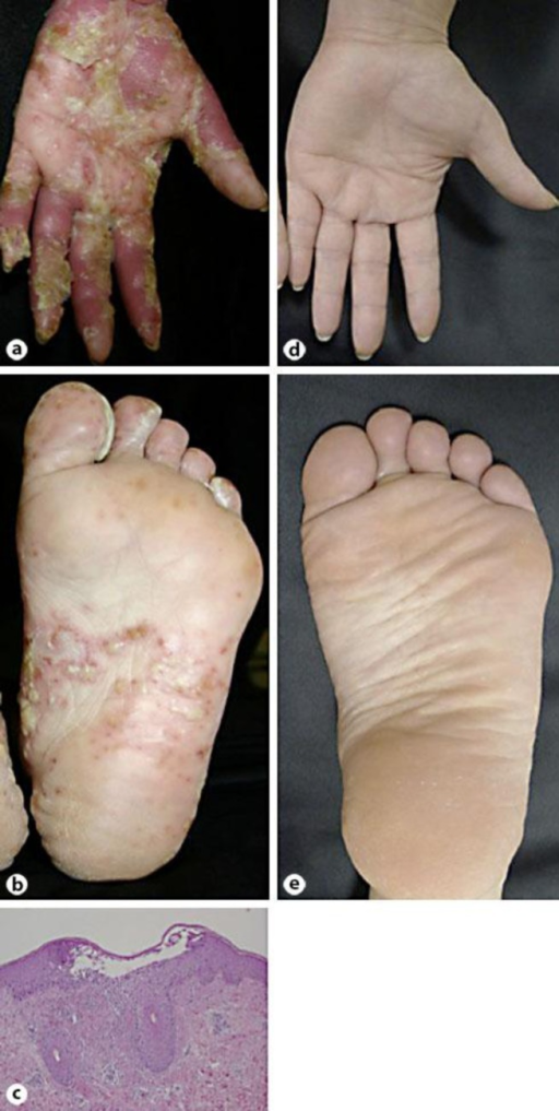 Clinical Appearances Of The Patient's Pustular Psoriati | Open-i