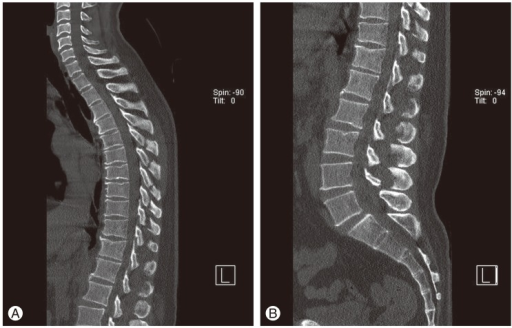 Sagittal View Of Computed Tomography Of A Thoracic Sp Open I 7119