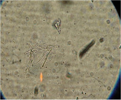 10% KOH mount shows hyaline septate hyphae. (Magnificat | Open-i