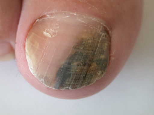 Fungal infection of the nail caused by Fusarium sp. Cau ...