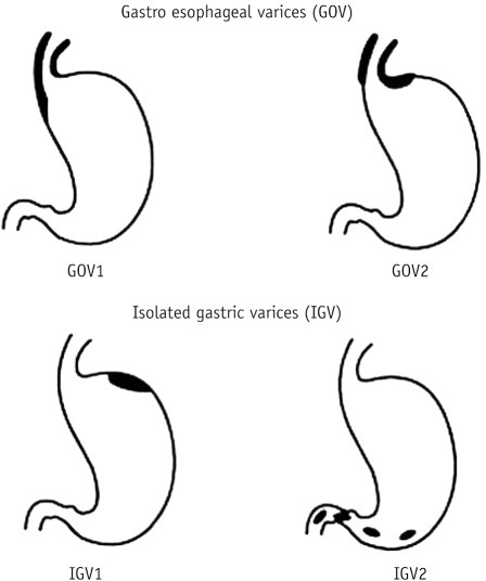 Classification of gastric varices. Adapted from Sarin ( | Open-i