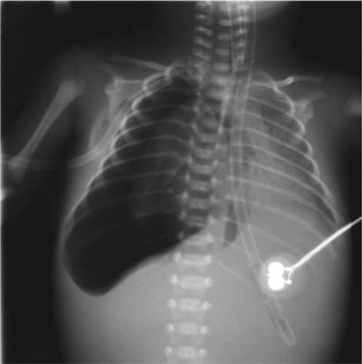 Neonatal Tension Pneumothorax