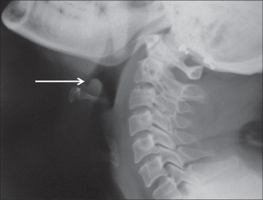 Lateral soft tissue radiograph of the neck showing “t | Open-i