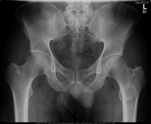 Ap View Of The Left Hip Shows A Geographic Lesion With 