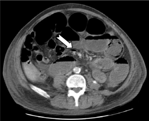 CT scan showing multiple dilated loops of small bowel  w 