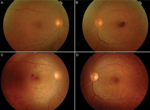 Fundus photography of subject with familial retinal art | Open-i