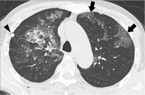 72-year-old man with bilateral re-expansion pulmonary e | Open-i