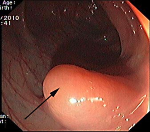 What is a hepatic flexure polyp?