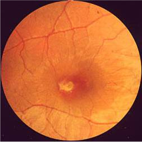 Nineteen Days Following The Exposure Fundoscopic Photography Revealed An Epiretinal Membrane With Retinal Folds Radiating Nineteen Days Following The Exposure Fundoscopic Photography Revealed An Epiretinal Membrane With Retinal Folds Radiating
