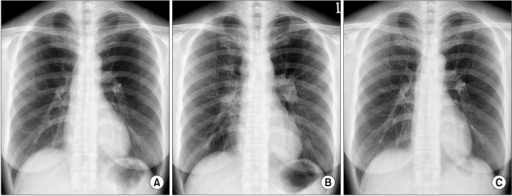 Trazodone discontinuation xray