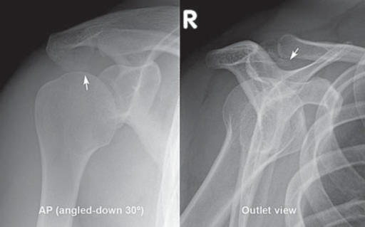 Anterior acromial bone spur (arrow). Radiographs are an | Open-i