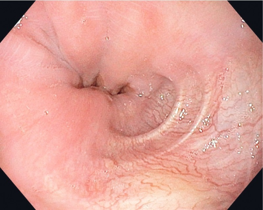 Pseudo Diverticulum At Lower End Of The Esophagus Afte Open I