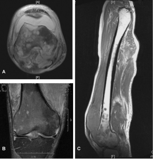 MRI demonstrating extensive medullary signal abnormalit | Open-i