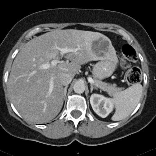 CT scan of the abdomen and pelvis; CT scan of the abdom | Open-i