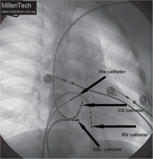 Fluoroscopic picture (RAO view, 30) showing ablation of | Open-i