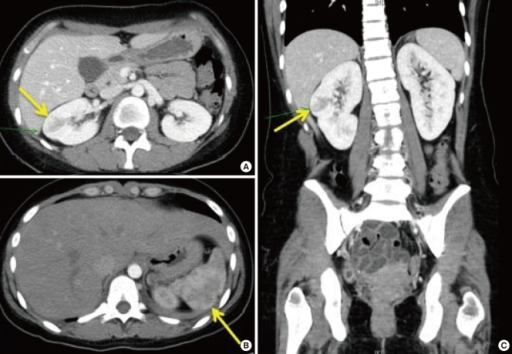 Abdominal Pelvic Ct Scan