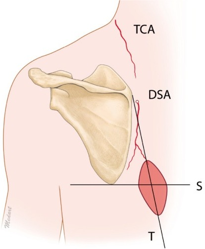 Preoperative design of the LTMC flapA Doppler ultrasoun ...