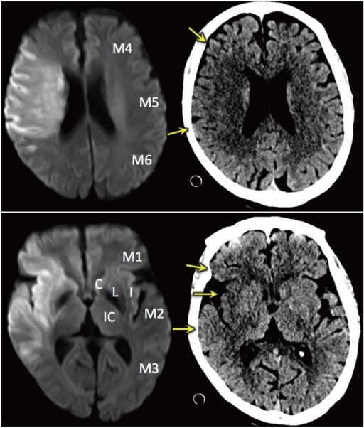 stroke-medicine-for-stroke-physicians-and-neurologists