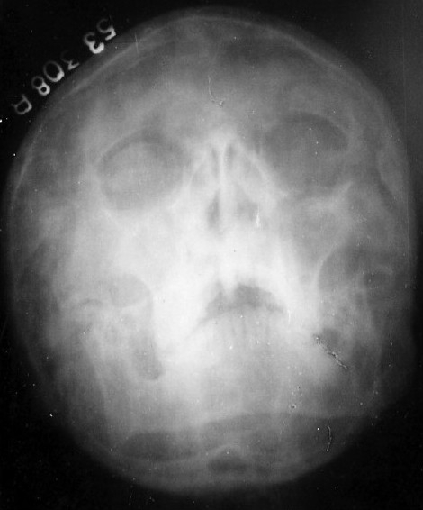 X-ray paranasal sinus showing maxillary sinusitis and b | Open-i