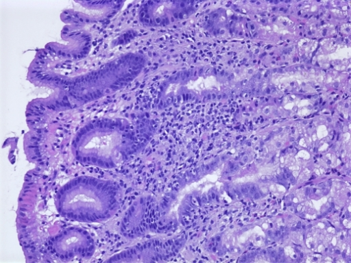 Histological section of a gastric biopsy showing modera | Open-i