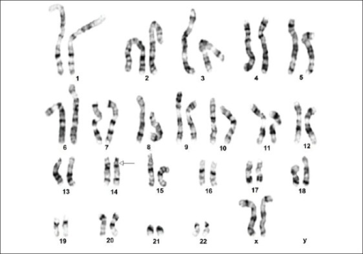 Karyogram of the cell line showing the deletion (14) (q | Open-i