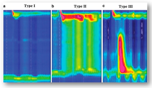 High Resolution Manometry Achalasia Type I Ii And Ii Open I