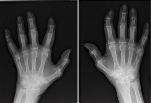 Osteopenia X Ray