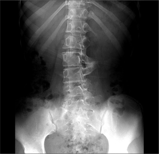 Simple radiograph of the patient. Simple anteroposterio | Open-i