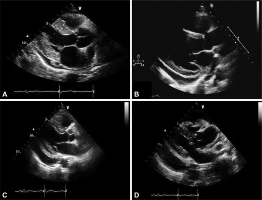 Echocardiographic grading of pericardial effusion as sc | Open-i