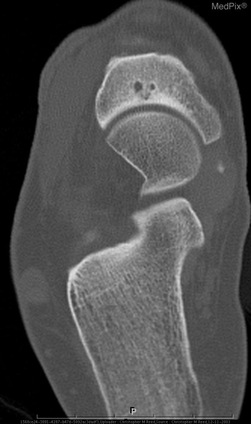 Cortical disruption at the proximal articular surface o | Open-i